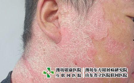 红苍狼斑的症状图片,揭秘神秘皮肤病特征