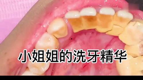 洗牙教学视频,掌握专业洗牙技巧全解析